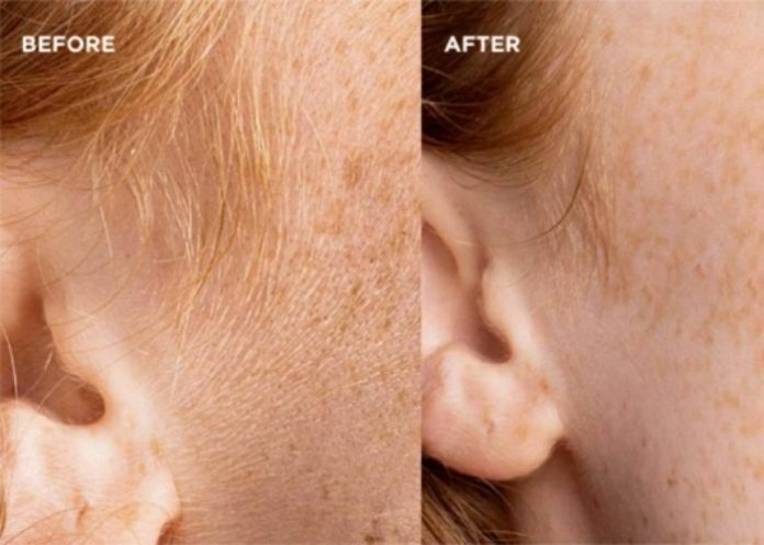 Dermaplaning Before and After Effects
