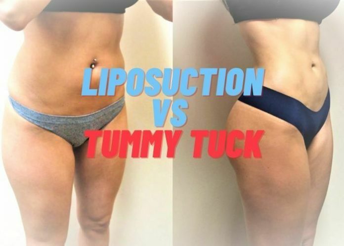 Liposuction Vs Tummy Tuck