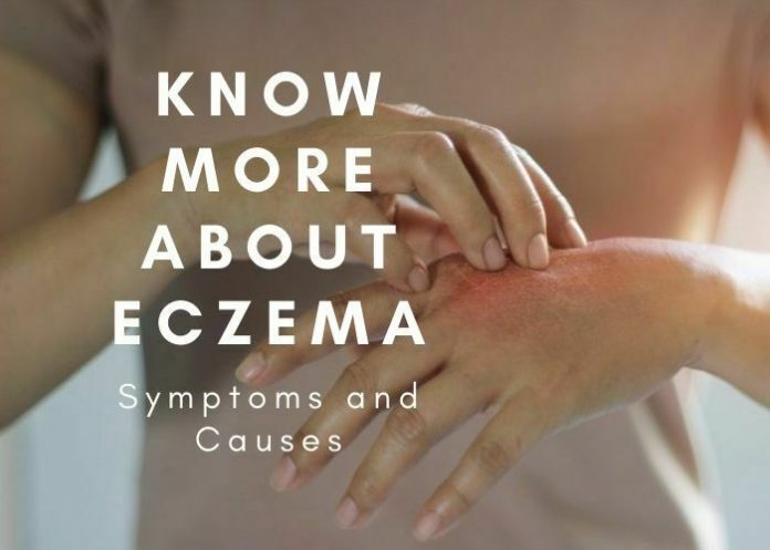 Know More About Eczema, Symptoms and Causes