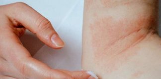 How Many Types of Eczema Are There